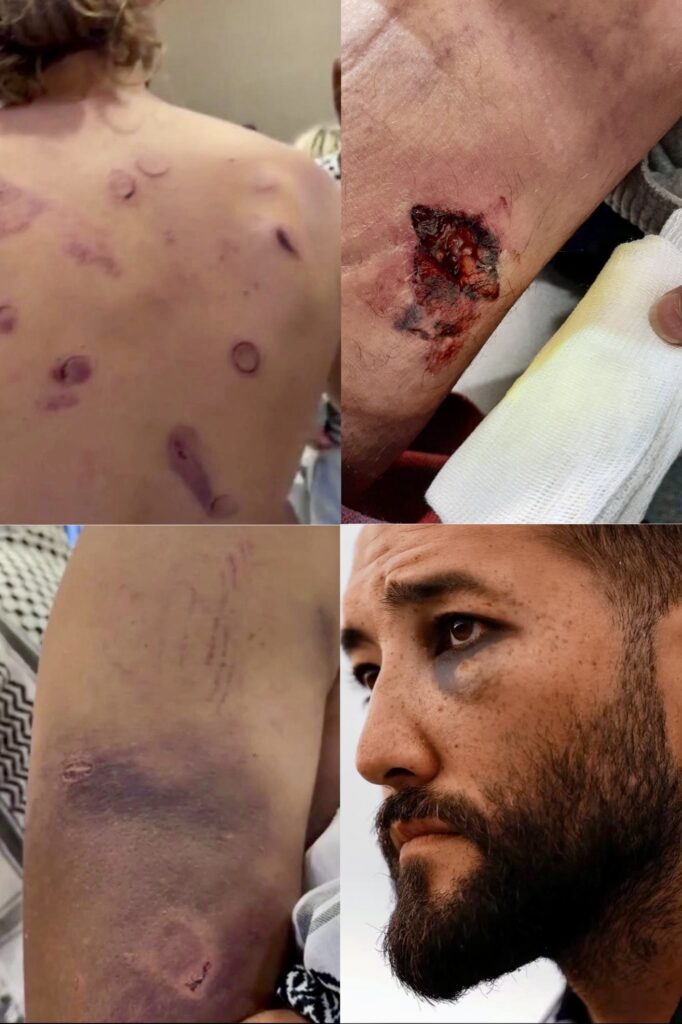 Collage of 4 photos showing different injuries sustained by Freedom Flotilla volunteers, 20260521